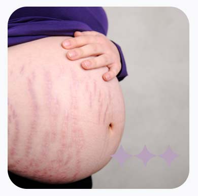 O que costuma causar estrias?