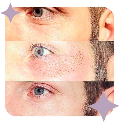 Como fica a pele após a aplicação do Jato de Plasma?