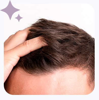 O que é o Microagulhamento Capilar?